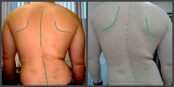 Craumatic al coloanei vertebrale cu osteochondroză