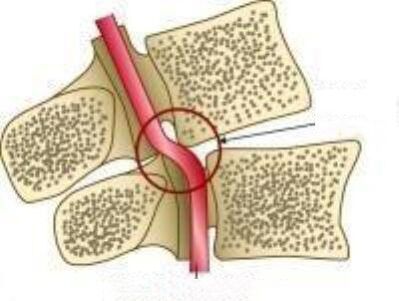 Sindromul arterelor Vail