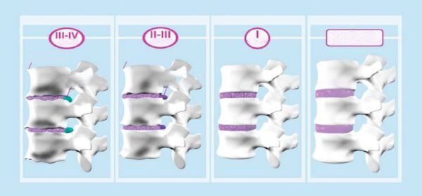 Stadioane de osteocondroză cervicală