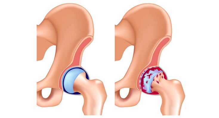 articulatia soldului sanatoasa afectata de osteoartrita